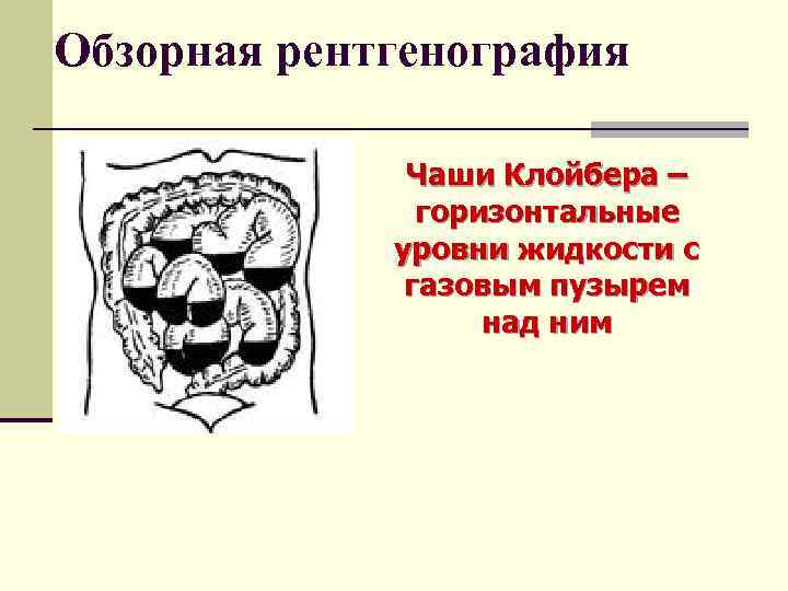Обзорная рентгенография    Чаши Клойбера –    горизонтальные  