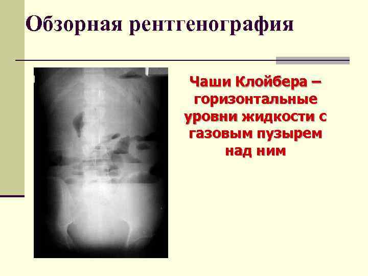 Обзорная рентгенография. Чаши Клойбера обзорная рентгенограмма. Тонкокишечная непроходимость рентген. Единичные чаши Клойбера.