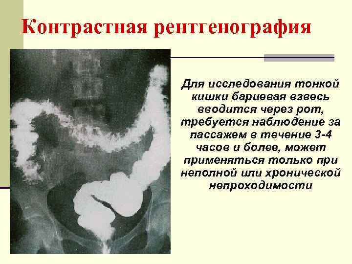 Пей пей кишки. Рентген исследование тонкого кишечника. Рентгеноскопия тонкого кишечника. Тонкий кишечник на рентгенограмме. Рентгеноскопия тонкой Кишк.