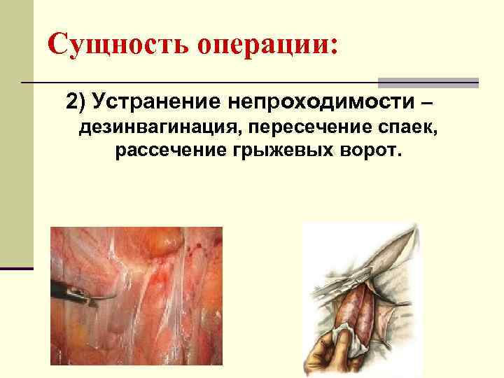 Сущность операции:  2) Устранение непроходимости –  дезинвагинация, пересечение спаек,  рассечение грыжевых