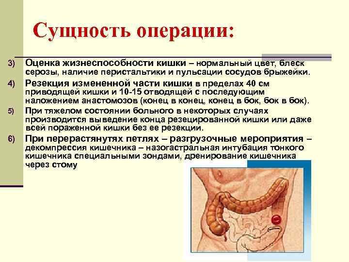  Сущность операции: 3)  Оценка жизнеспособности кишки – нормальный цвет, блеск серозы, наличие