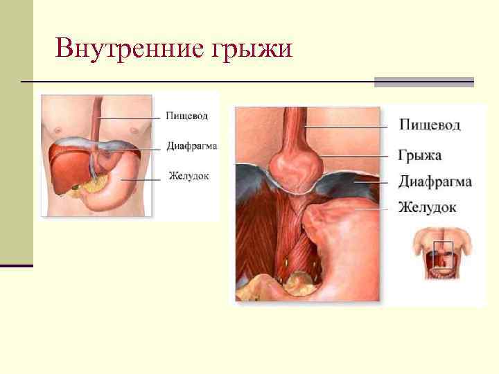 Внутренние грыжи 