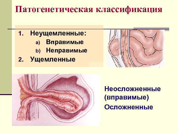 Патогенетическая классификация 1.  Неущемленные:  a)  Вправимые  b)  Неправимые 2.