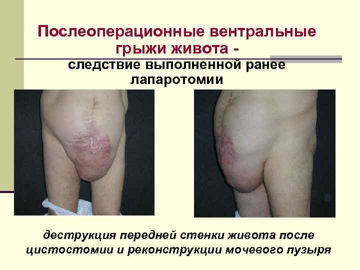 Послеоперационные вентральные   грыжи живота - следствие выполненной ранее   лапаротомии