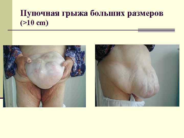Пупочная грыжа больших размеров (>10 cm) 