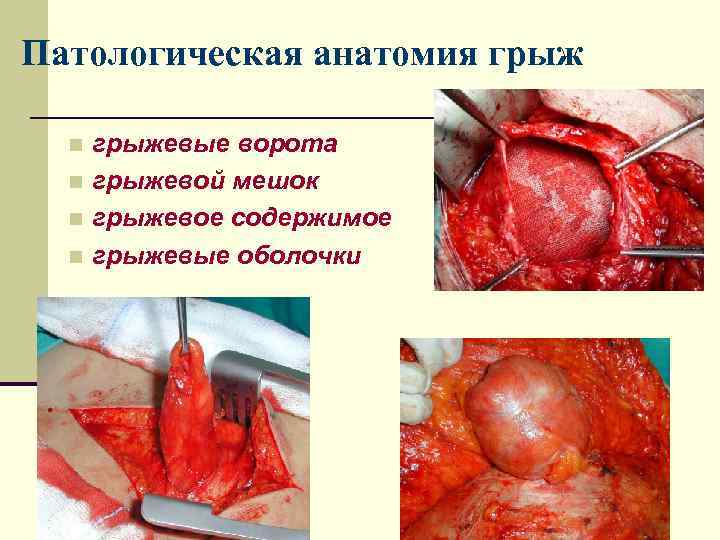 Патологическая анатомия грыж  n грыжевые ворота  n грыжевой мешок  n грыжевое