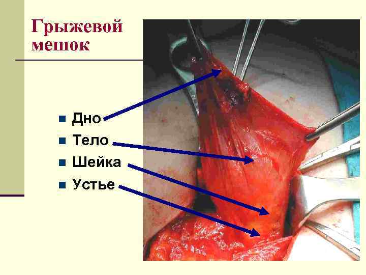Грыжевой мешок n  Дно  n  Тело  n  Шейка 