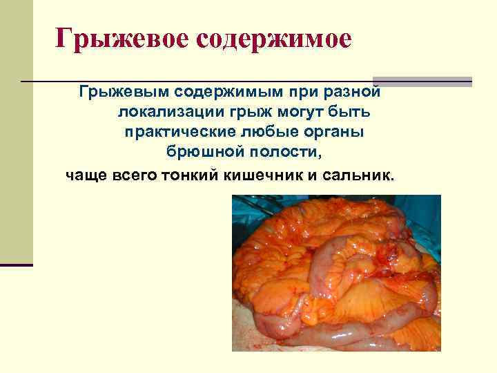 Грыжевое содержимое Грыжевым содержимым при разной  локализации грыж могут быть  практические любые