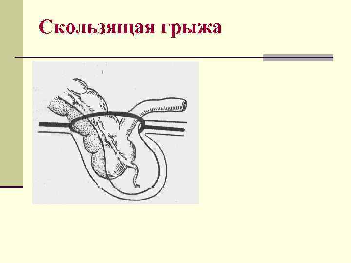 Скользящая грыжа 