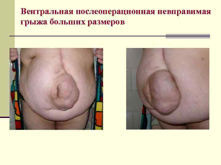 Вентральная послеоперационная невправимая грыжа больших размеров 