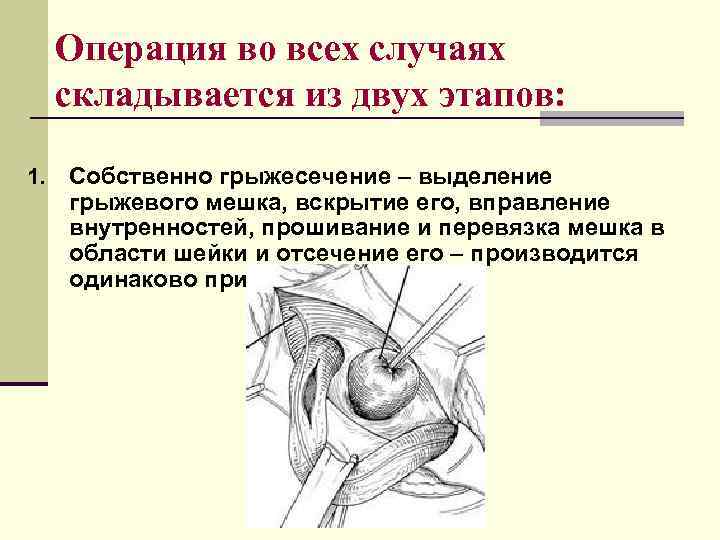  Операция во всех случаях складывается из двух этапов:  1.  Собственно грыжесечение