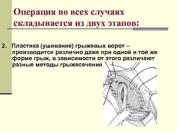   Операция во всех случаях  складывается из двух этапов:  2. Пластика
