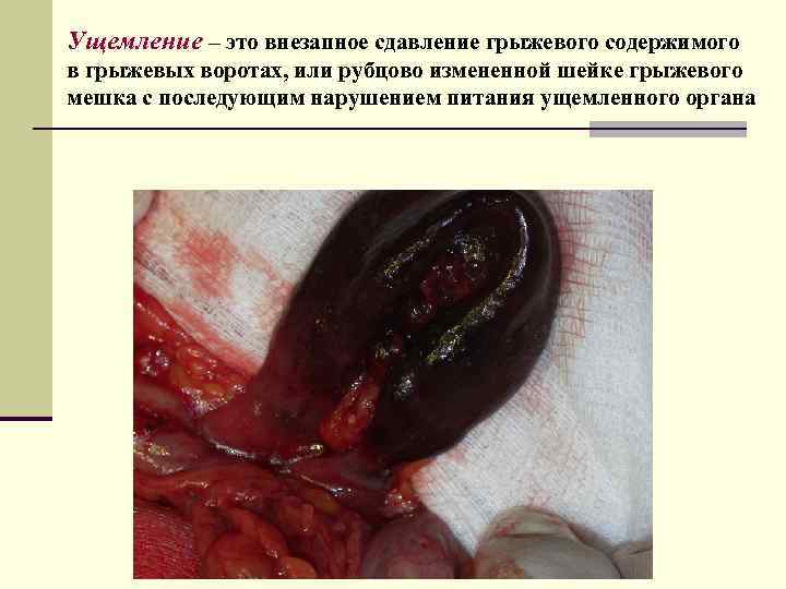 Ущемление – это внезапное сдавление грыжевого содержимого в грыжевых воротах, или рубцово измененной шейке