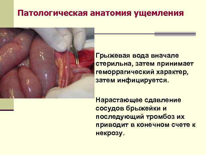 Патологическая анатомия ущемления   Ø Грыжевая вода вначале    стерильна, затем
