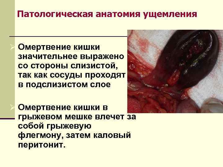  Патологическая анатомия ущемления  Ø Омертвение кишки значительнее выражено со стороны слизистой, 