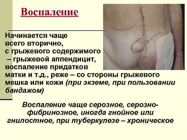  Воспаление Начинается чаще всего вторично, с грыжевого содержимого – грыжевой аппендицит, воспаление