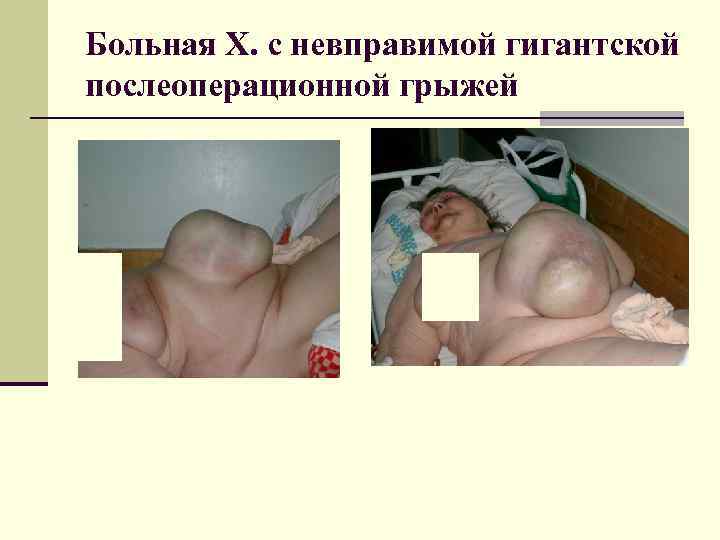 Больная Х. с невправимой гигантской послеоперационной грыжей 