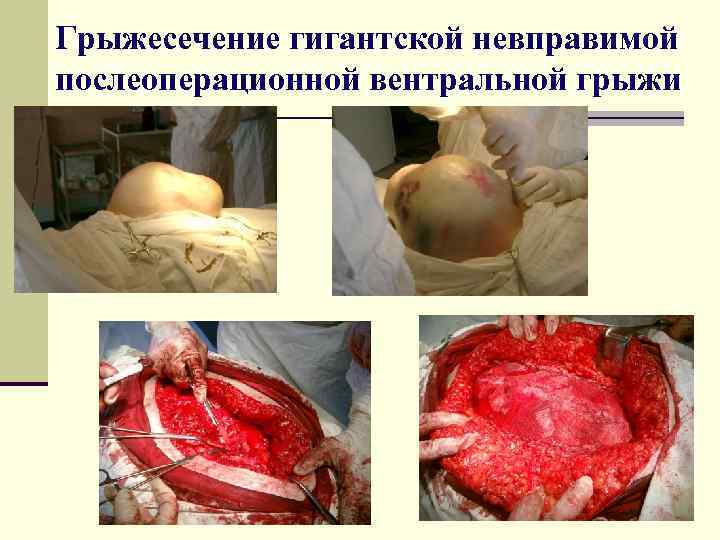 Грыжесечение гигантской невправимой послеоперационной вентральной грыжи 