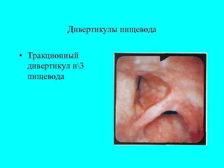  Дивертикулы пищевода  • Тракционный  дивертикул н3  пищевода 