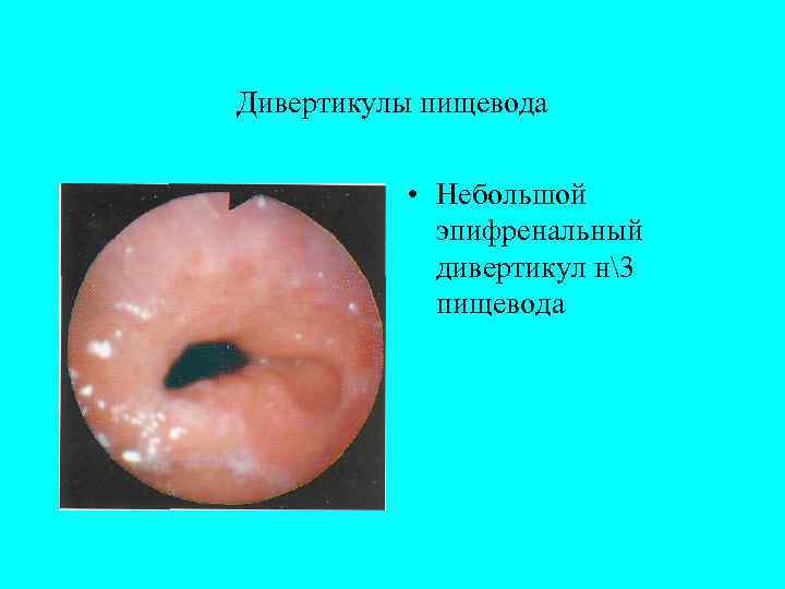 Дивертикулы пищевода   • Небольшой   эпифренальный   дивертикул н3 