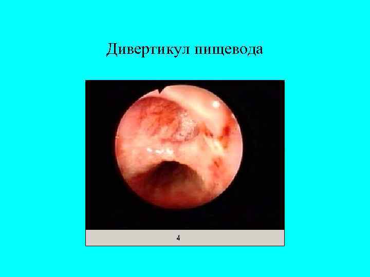 Дивертикул пищевода 