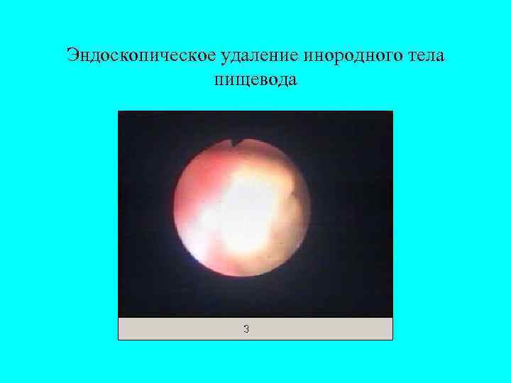 Эндоскопическое удаление инородного тела    пищевода 
