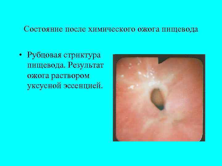  Состояние после химического ожога пищевода  • Рубцовая стриктура  пищевода. Результат 