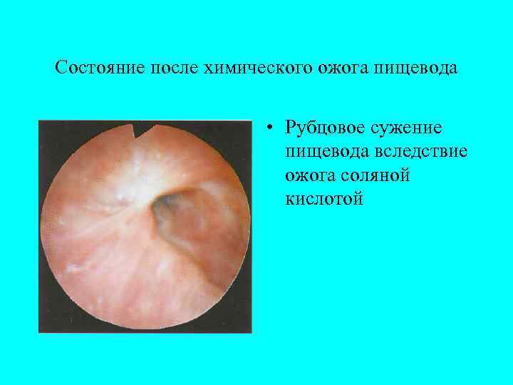 Состояние после химического ожога пищевода    • Рубцовое сужение   