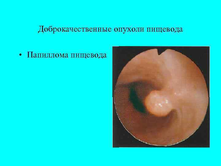   Доброкачественные опухоли пищевода  • Папиллома пищевода 