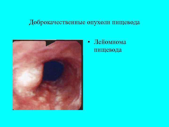 Доброкачественные опухоли пищевода    • Лейомиома    пищевода 