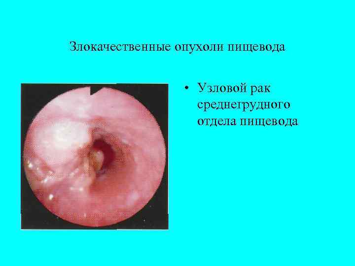 Злокачественные опухоли пищевода    • Узловой рак    среднегрудного 