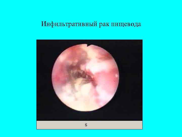 Инфильтративный рак пищевода 