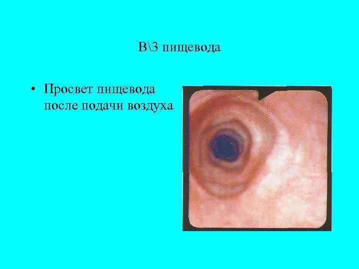     В3 пищевода  • Просвет пищевода  после подачи воздуха