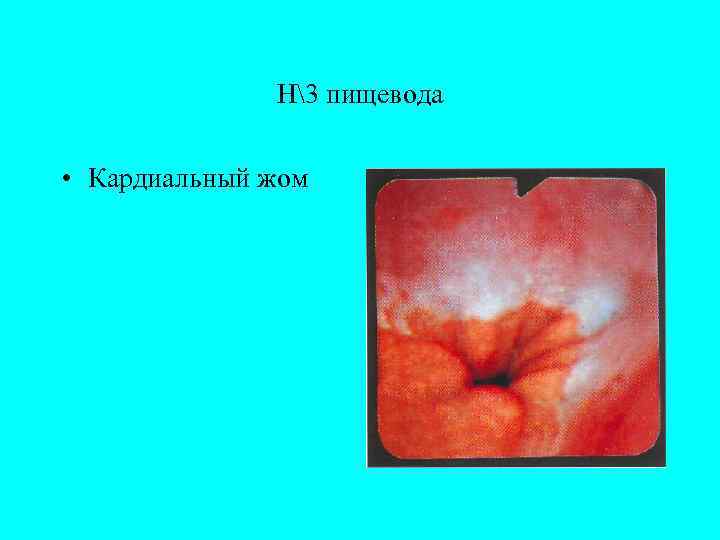   Н3 пищевода  • Кардиальный жом 