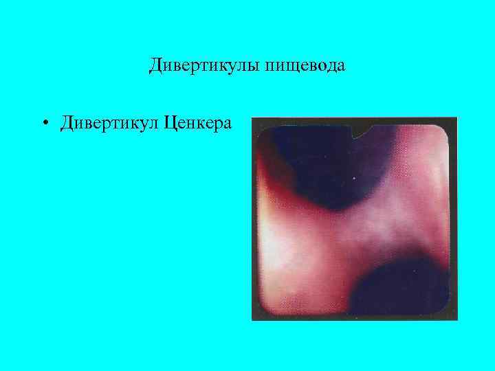   Дивертикулы пищевода  • Дивертикул Ценкера 
