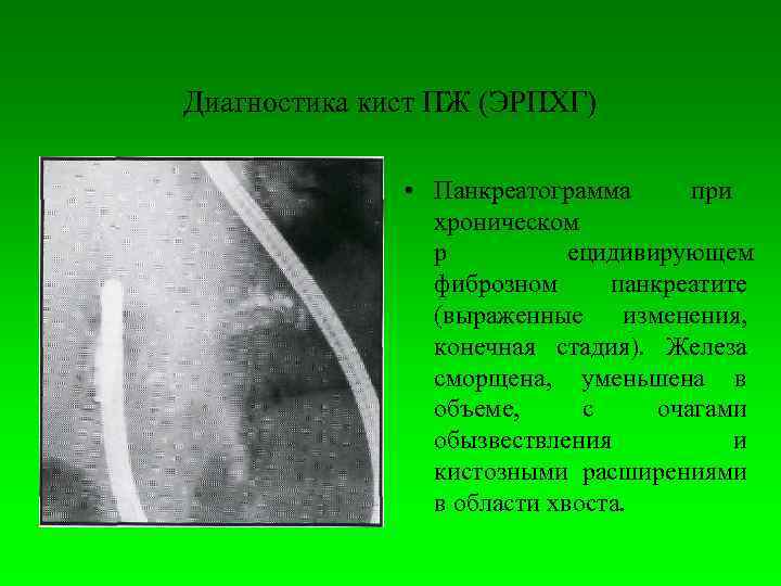   Диагностика кист ПЖ (ЭРПХГ)  • Панкреатограмма  при   