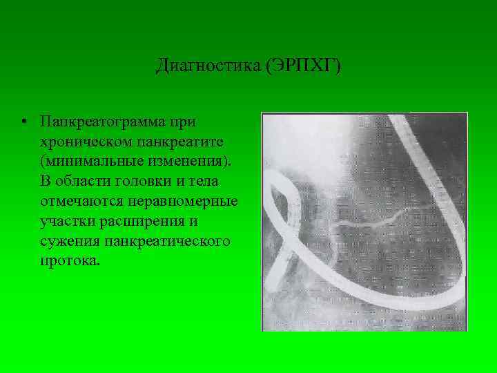      Диагностика (ЭРПХГ)  • Папкреатограмма при  хроническом панкреатите