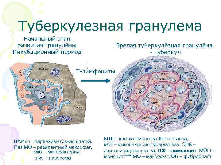  Туберкулезная гранулема  Начальный этап развития гранулёмы    Зрелая туберкулёзная гранулёма