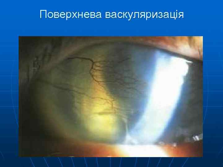 Поверхнева васкуляризація 