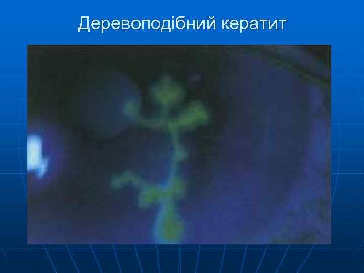 Деревоподібний кератит 