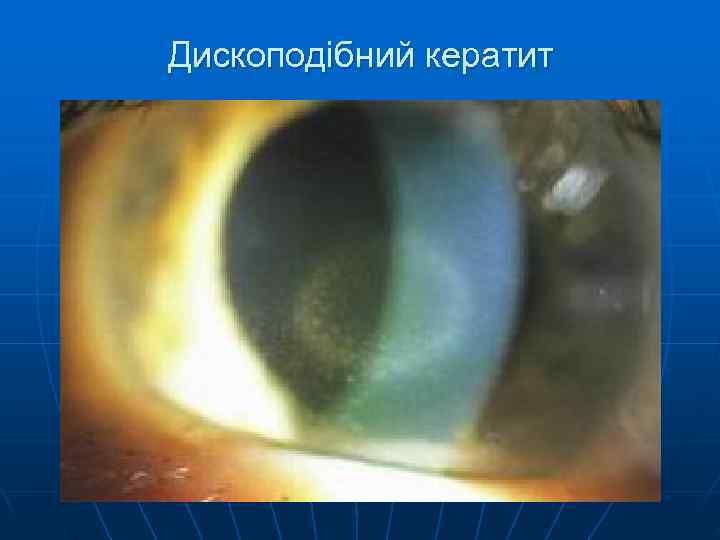 Дископодібний кератит 