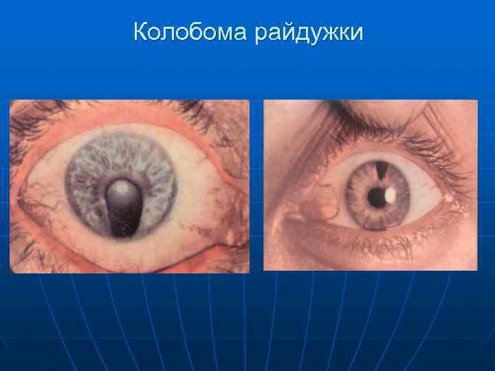 Колобома райдужки 