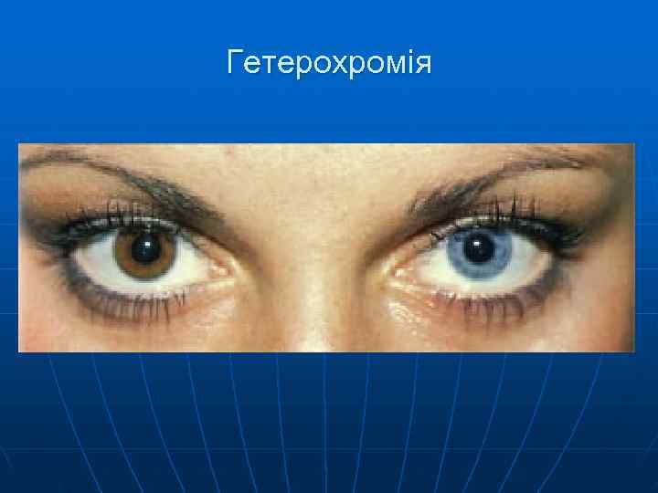 Гетерохромія 