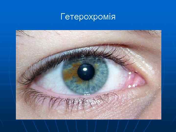 Гетерохромія 