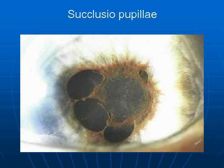 Succlusio pupillae 