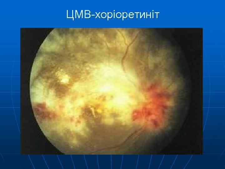 ЦМВ-хоріоретиніт 