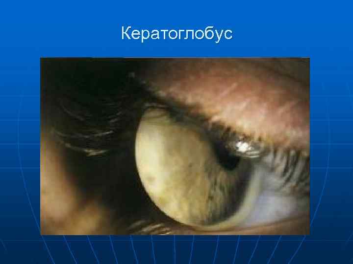 Кератоглобус 