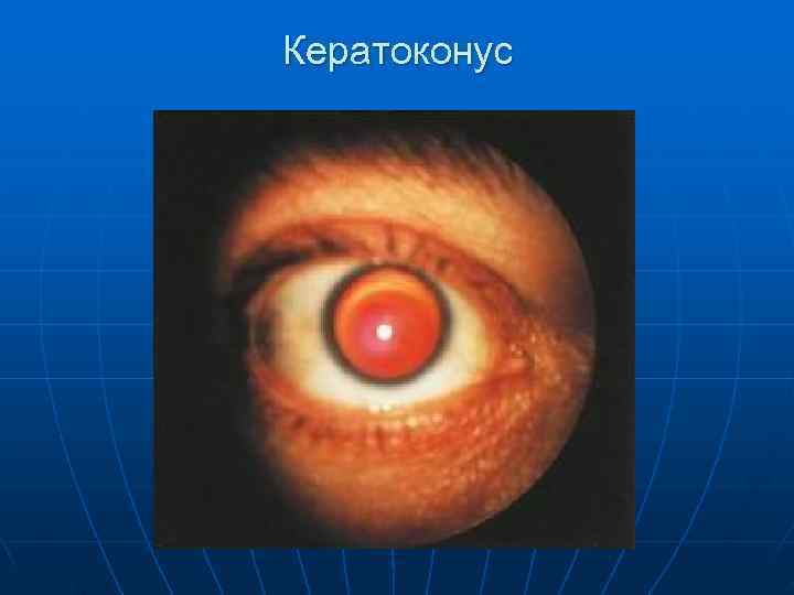 Кератоконус 