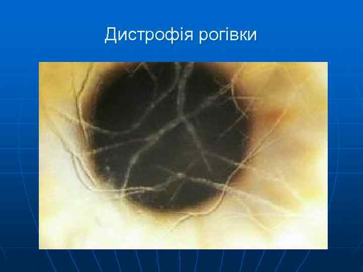 Дистрофія рогівки 