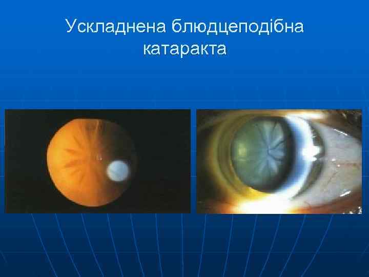 Ускладнена блюдцеподібна   катаракта 